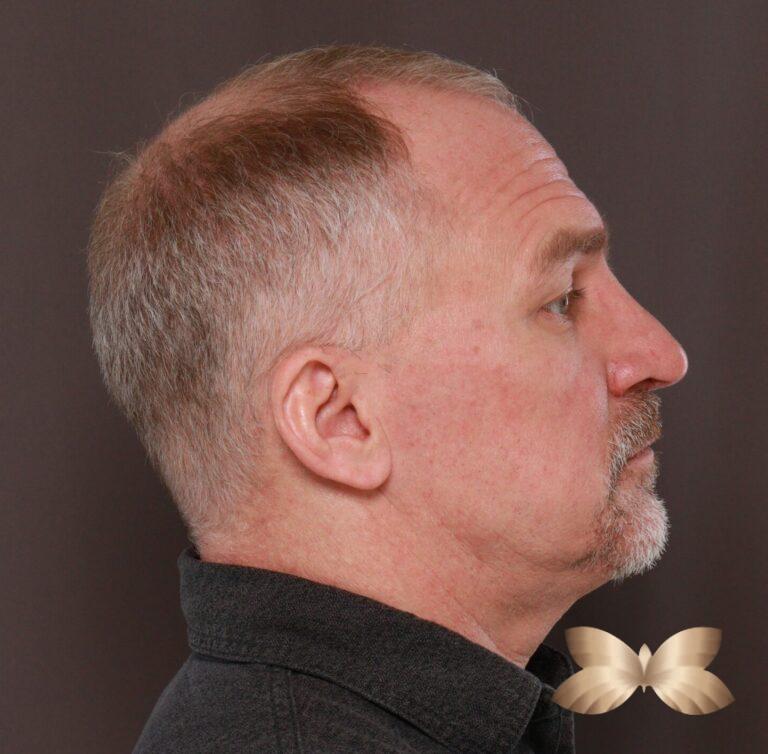 After Image: Rhinoplasty by Dr. Henstrom - front