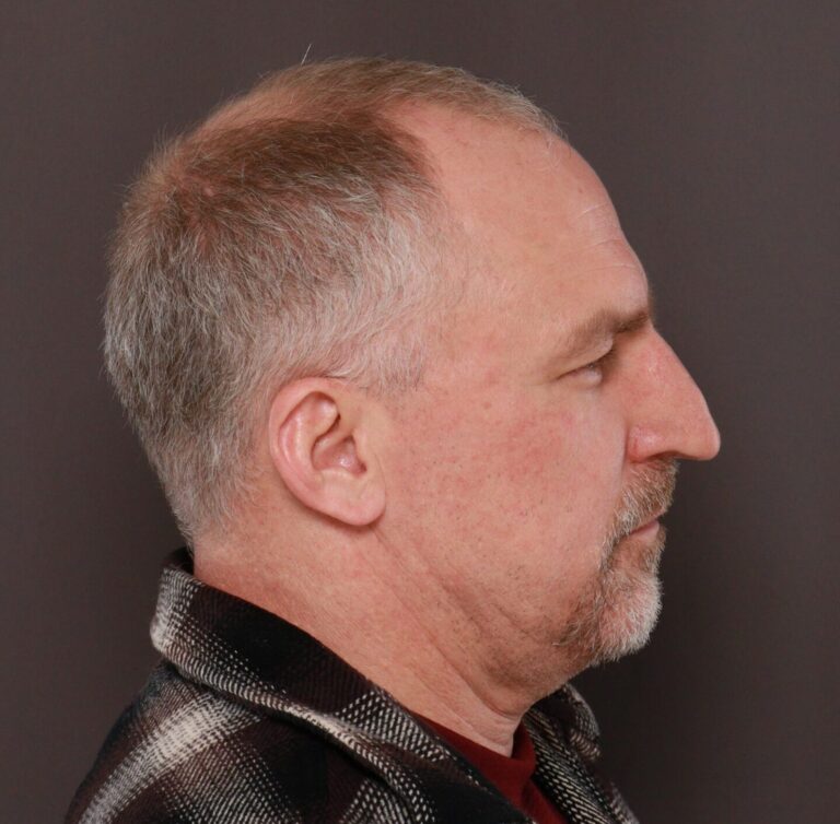 Before Image: Rhinoplasty by Dr. Henstrom - front