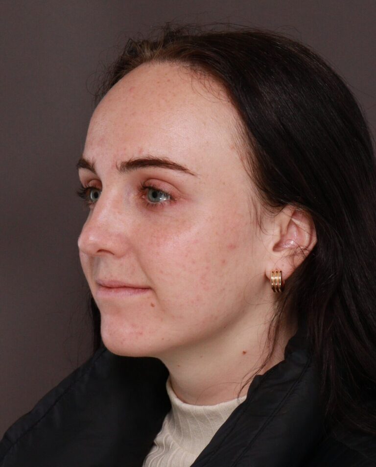 Before Image: Forehead Reduction by Dr. Manning - left-front-oblique