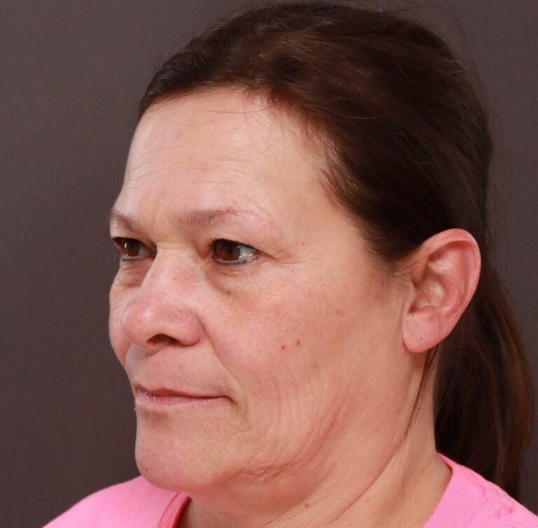 Before Image: MACSlift and Upper Blepharoplasty by Dr. Henstrom - left-front-oblique