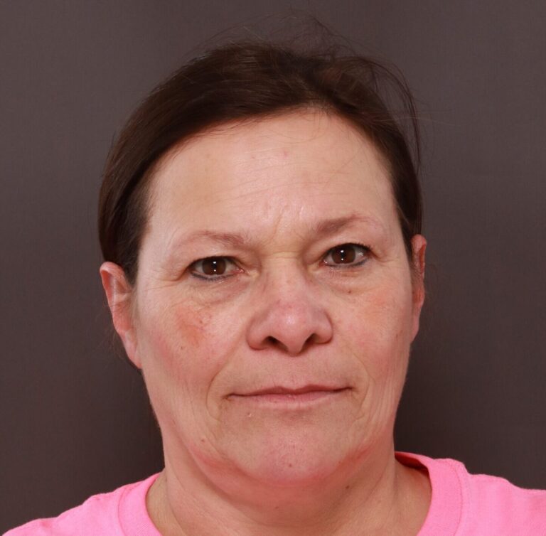 Before Image: MACSlift and Upper Blepharoplasty by Dr. Henstrom - front