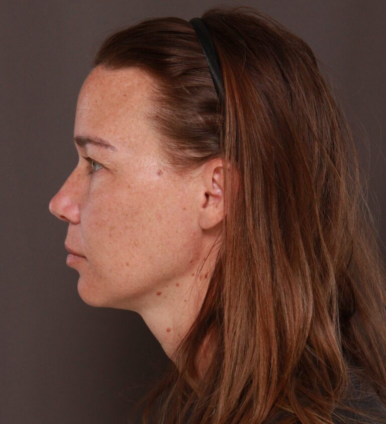 Before Image: Upper Blepharoplasty by Dr. Manning - left-side