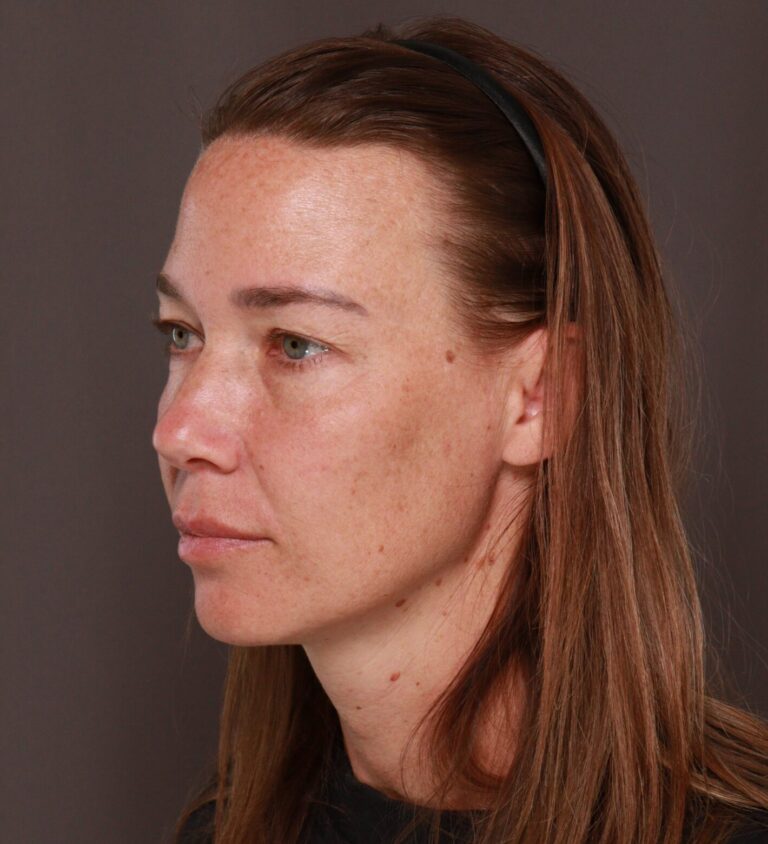 Before Image: Upper Blepharoplasty by Dr. Manning - left-front-oblique