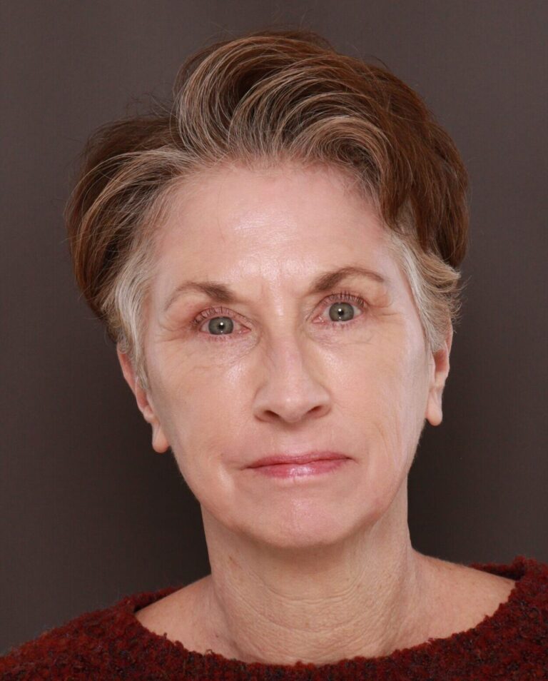 After Image: Upper & Lower Blepharoplasty, Periorbital Fat Grafting and Contour TRL by Dr. Manning - front