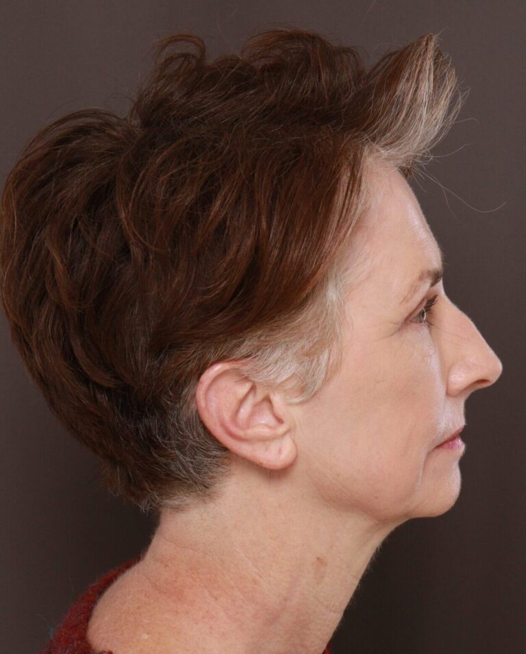After Image: Upper & Lower Blepharoplasty, Periorbital Fat Grafting and Contour TRL by Dr. Manning - right-side