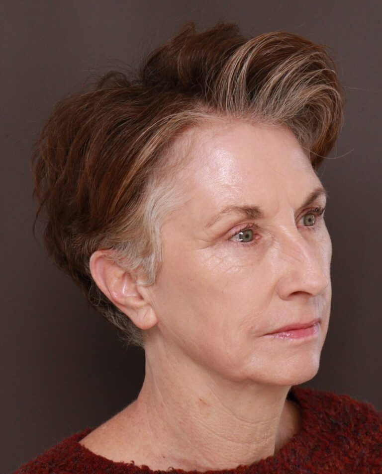 After Image: Upper & Lower Blepharoplasty, Periorbital Fat Grafting and Contour TRL by Dr. Manning - right-front-oblique