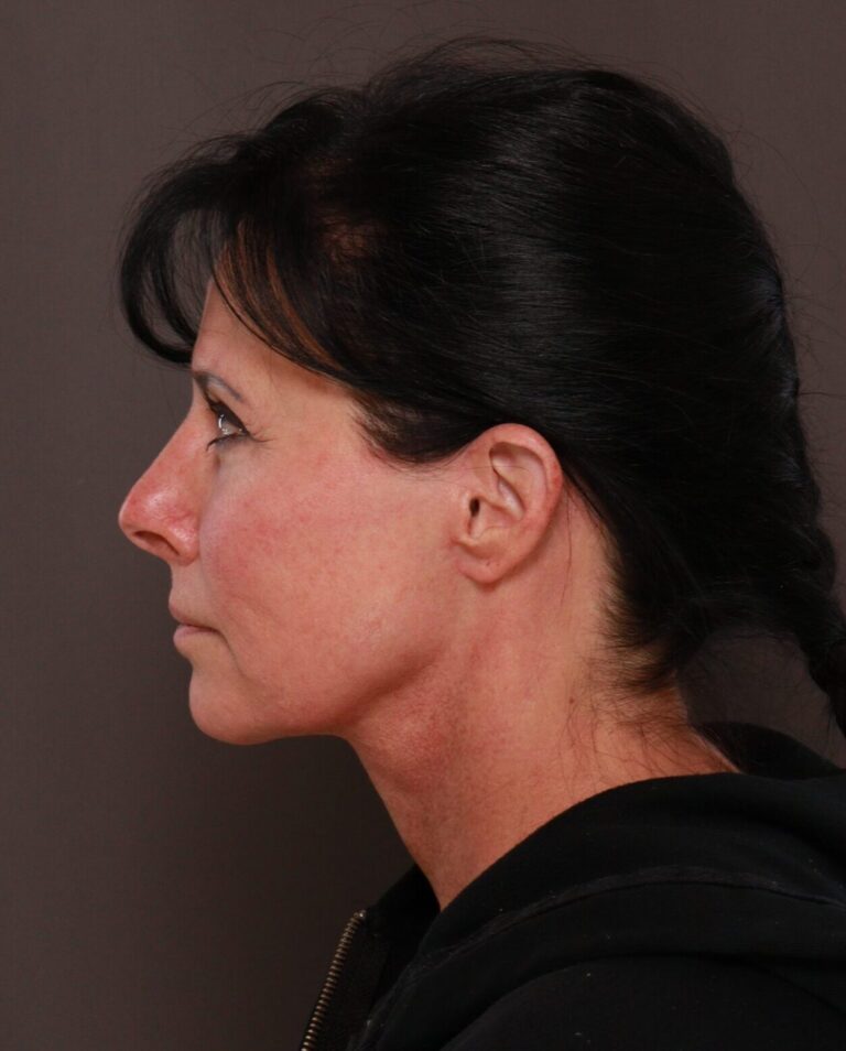 After Image: Macslift & Deep Neck Contouring by Dr. Manning - left-side