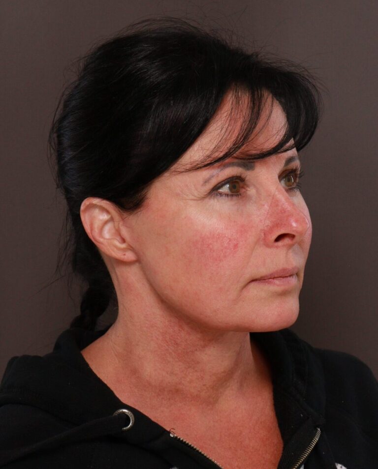 After Image: Macslift & Deep Neck Contouring by Dr. Manning - right-front-oblique