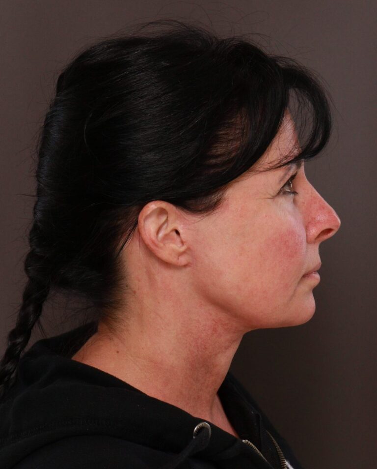 After Image: Macslift & Deep Neck Contouring by Dr. Manning - right-side