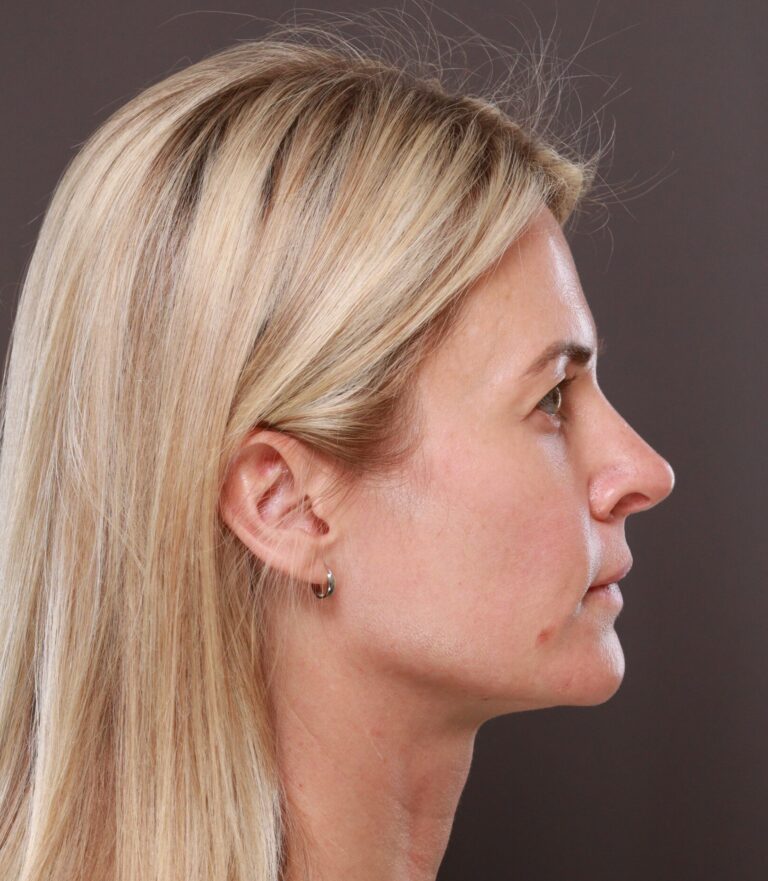 Before Image: Browlift by Dr. Thompson - right-side