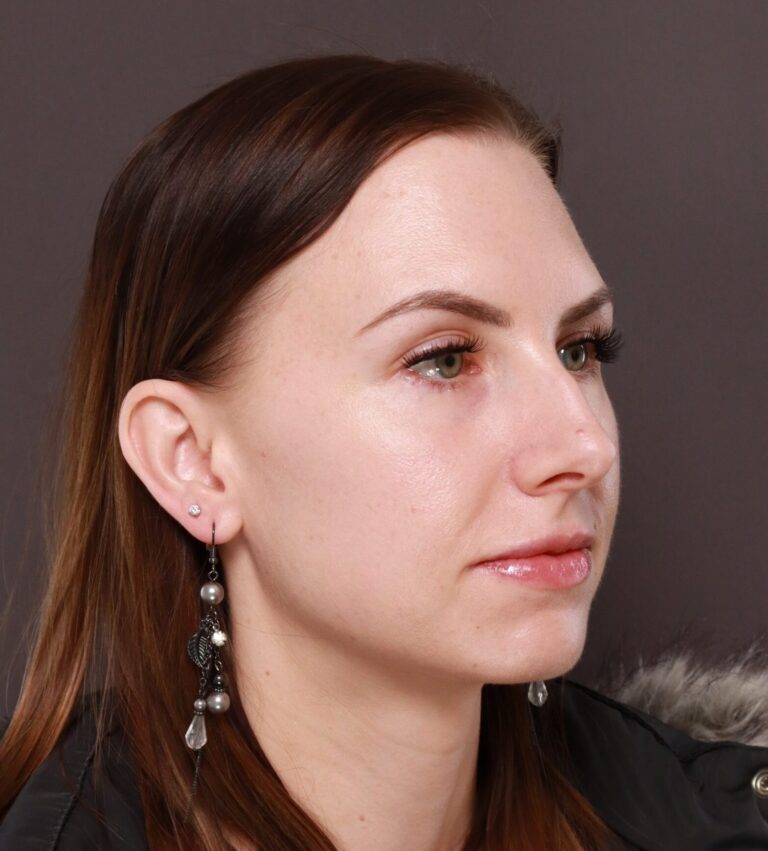 Before Image: Rhinoplasty by Dr. Henstrom - right-front-oblique