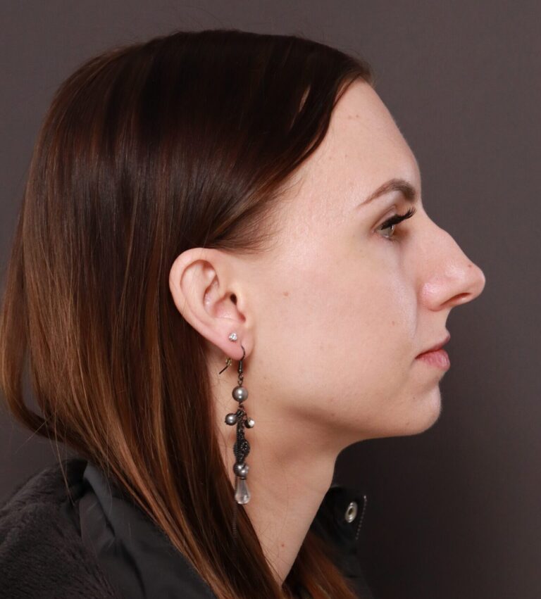 Before Image: Rhinoplasty by Dr. Henstrom - right-side