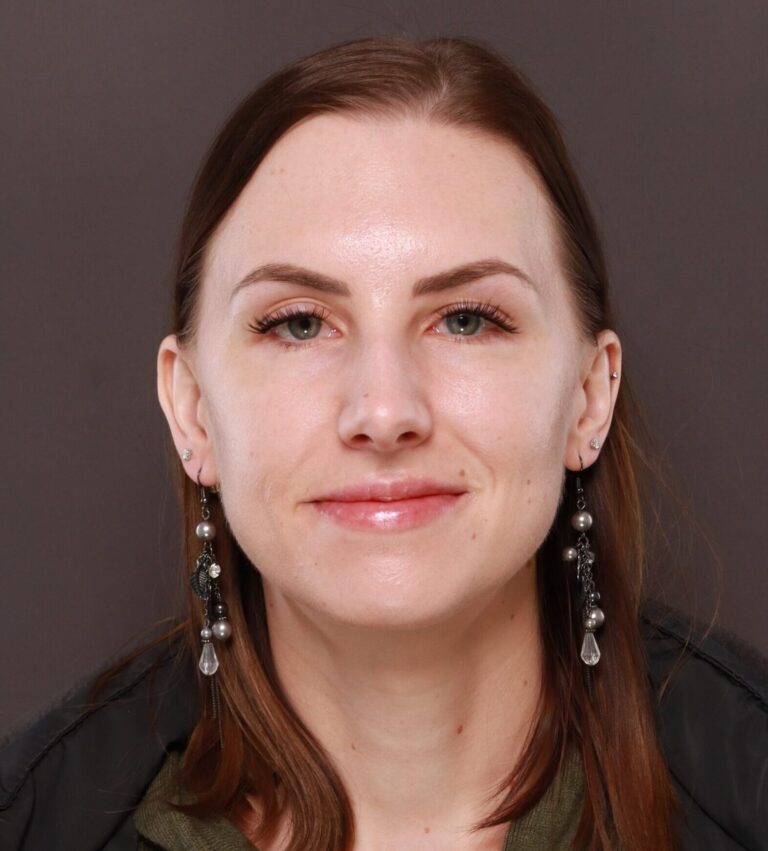 Before Image: Rhinoplasty by Dr. Henstrom - front