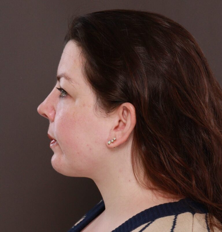 After Image: Deep Neck Contouring by Dr. Manning - left-side