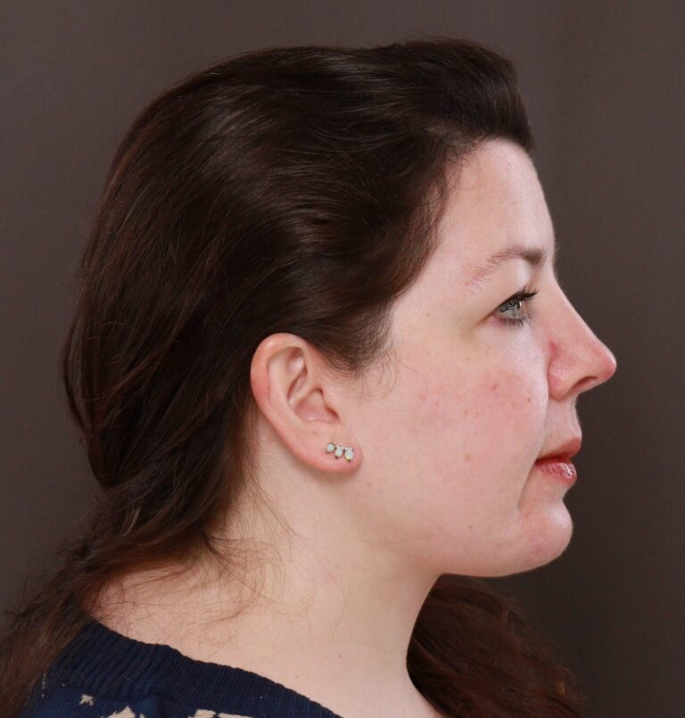 After Image: Deep Neck Contouring by Dr. Manning - right-side