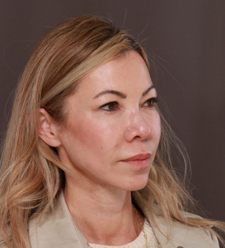 After Image: Upper Blepharoplasty by Dr. Manning - right-front-oblique