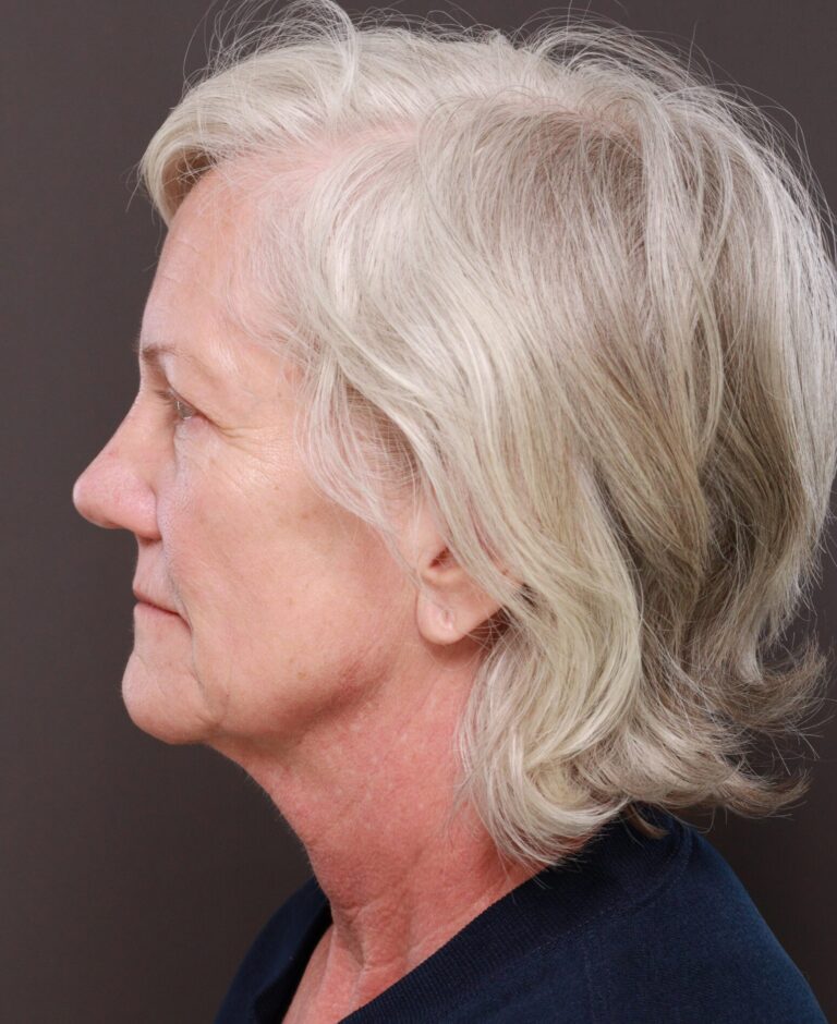 Before Image: Facelift & Lower Blepharoplasty by Dr. Thompson, Contour TRL by Dr. Manning - left-side