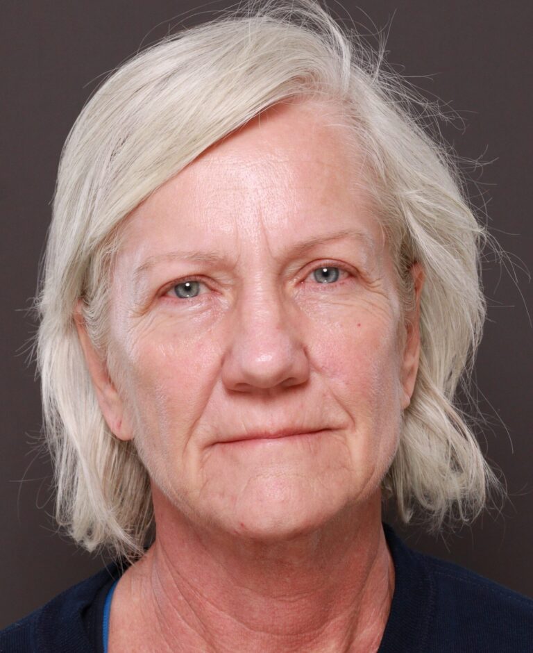 Before Image: Facelift & Lower Blepharoplasty by Dr. Thompson, Contour TRL by Dr. Manning - front