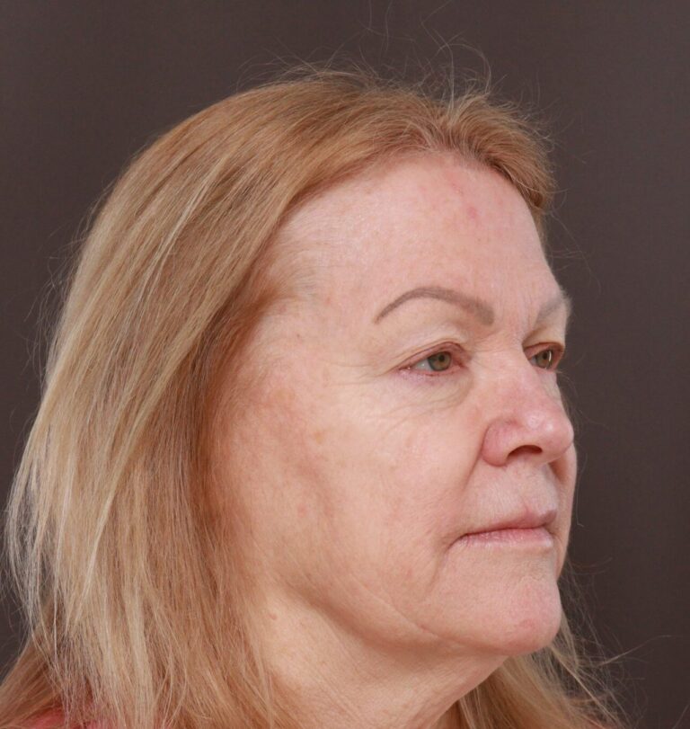 Before Image: Upper Blepharoplasty by Dr. Manning - right-front-oblique