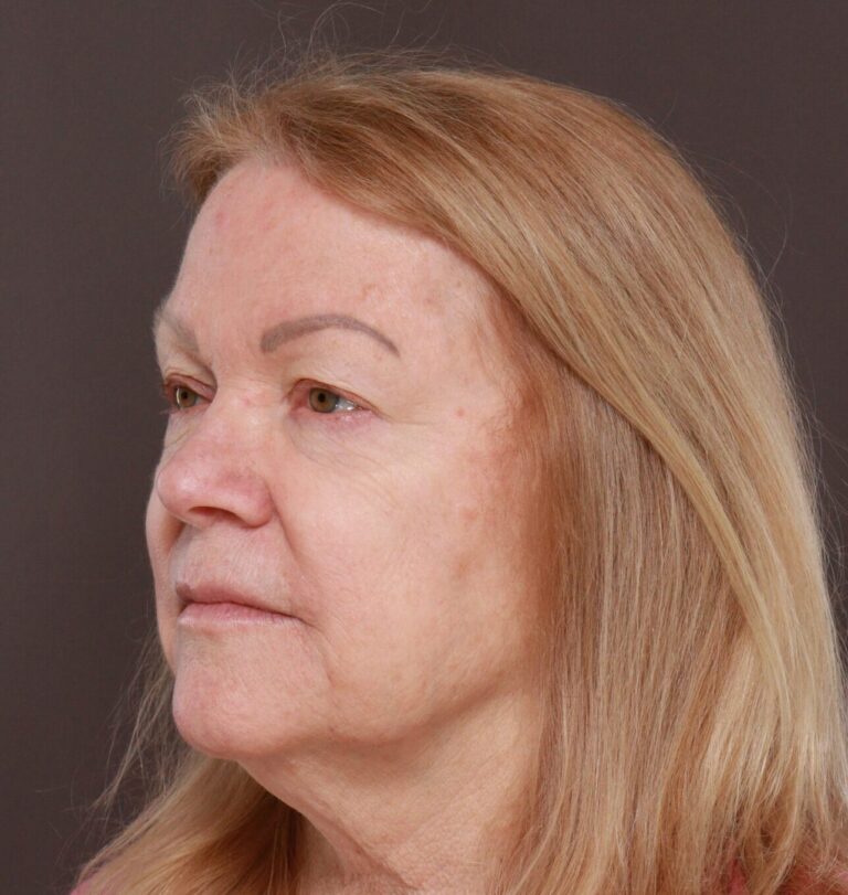 Before Image: Upper Blepharoplasty by Dr. Manning - left-front-oblique