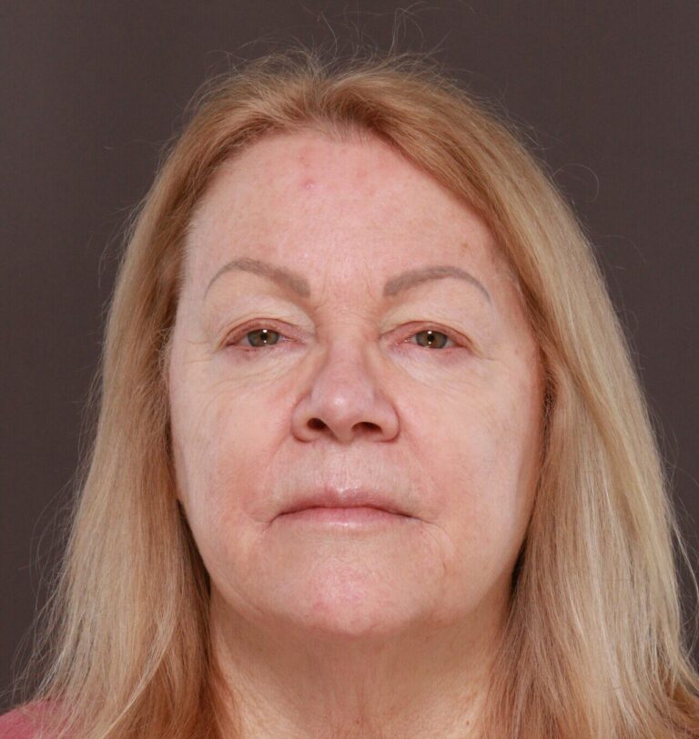 Before Image: Upper Blepharoplasty by Dr. Manning - front