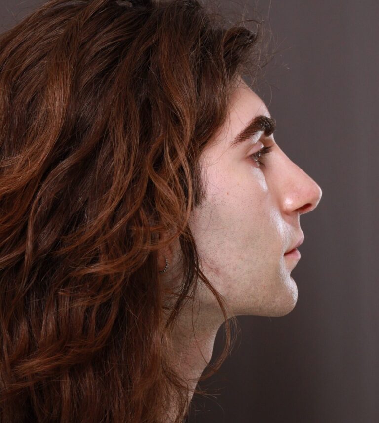 After Image: Rhinoplasty by Dr. Henstrom - right-side