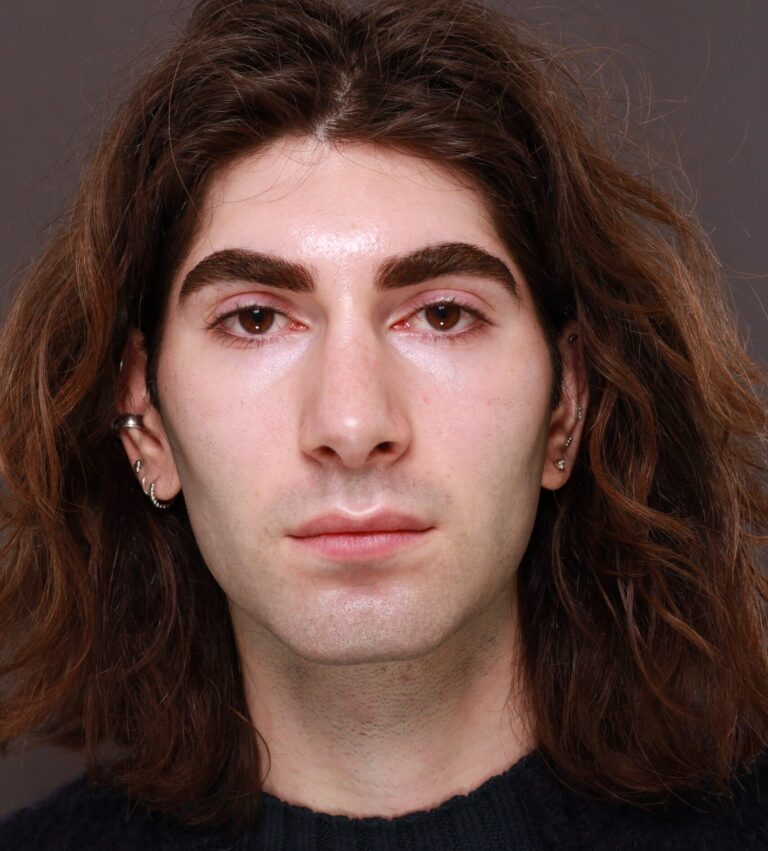 After Image: Rhinoplasty by Dr. Henstrom - front