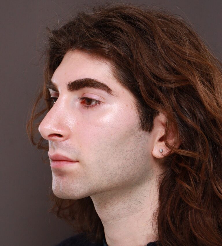 After Image: Rhinoplasty by Dr. Henstrom - left-front-oblique