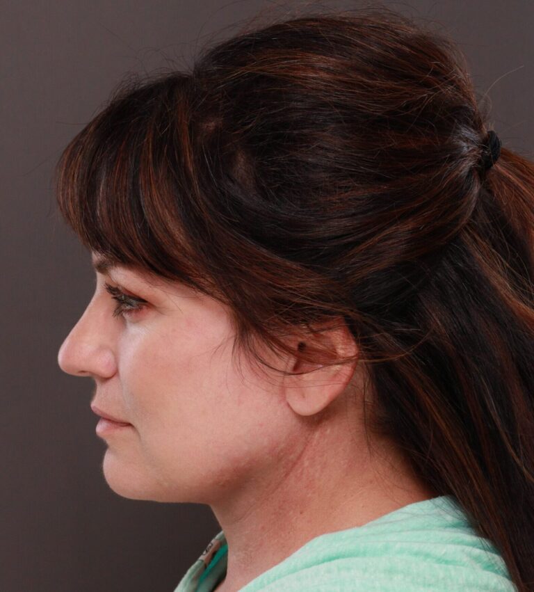 After Image: Facelift and Browlift by Dr. Thompson - left-side