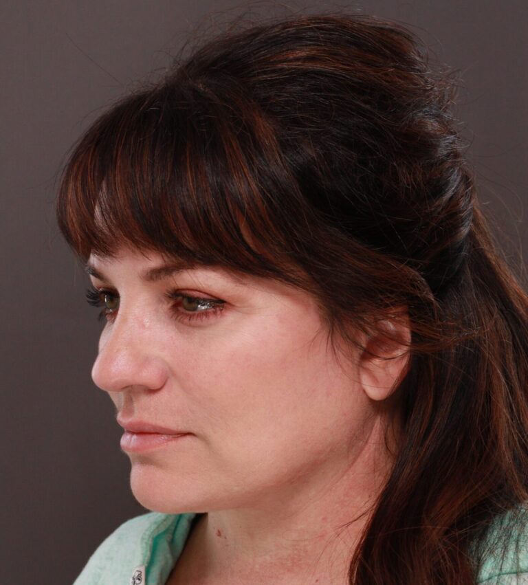 After Image: Facelift and Browlift by Dr. Thompson - left-front-oblique