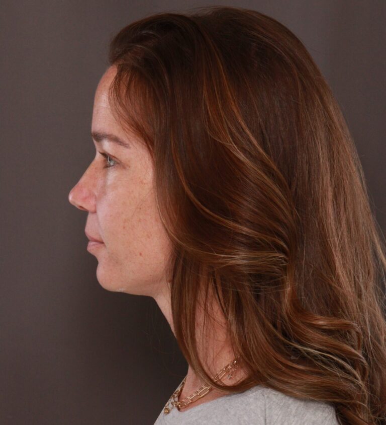 After Image: Upper Blepharoplasty by Dr. Manning - left-side