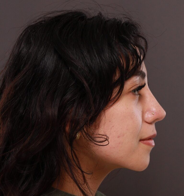 After Image: Rhinoplasty by Dr. Manning - right-side