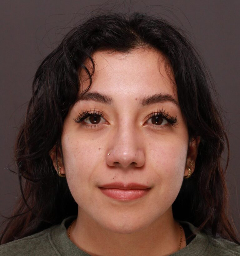 After Image: Rhinoplasty by Dr. Manning - front
