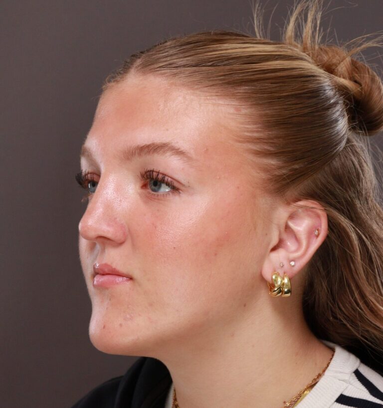After Image: Rhinoplasty by Dr. Manning - left-front-oblique