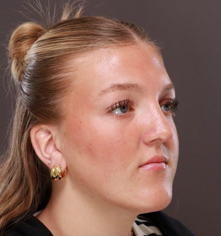 After Image: Rhinoplasty by Dr. Manning - right-front-oblique
