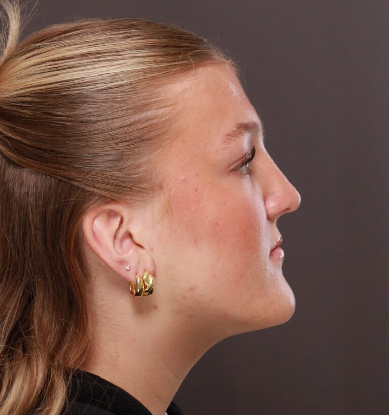 After Image: Rhinoplasty by Dr. Manning - right-side