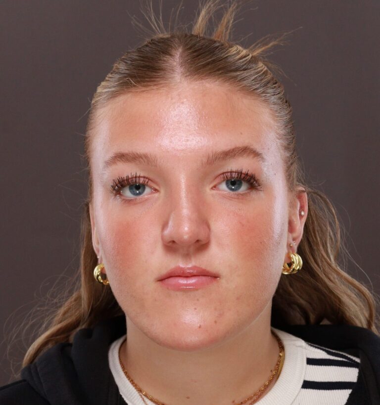 After Image: Rhinoplasty by Dr. Manning - front