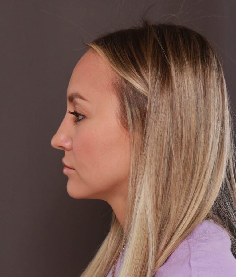 After Image: Forehead Reduction by Dr. Thompson - left-side