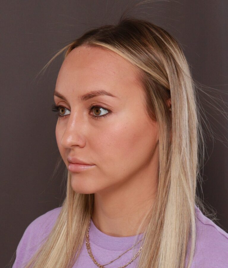 After Image: Forehead Reduction by Dr. Thompson - left-front-oblique