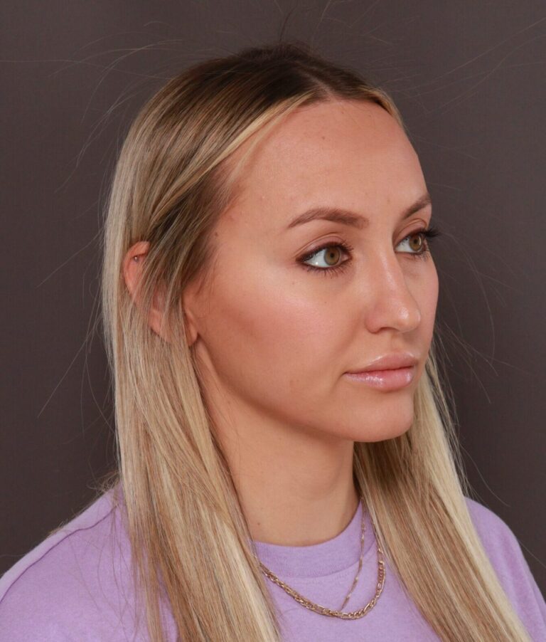 After Image: Forehead Reduction by Dr. Thompson - right-front-oblique