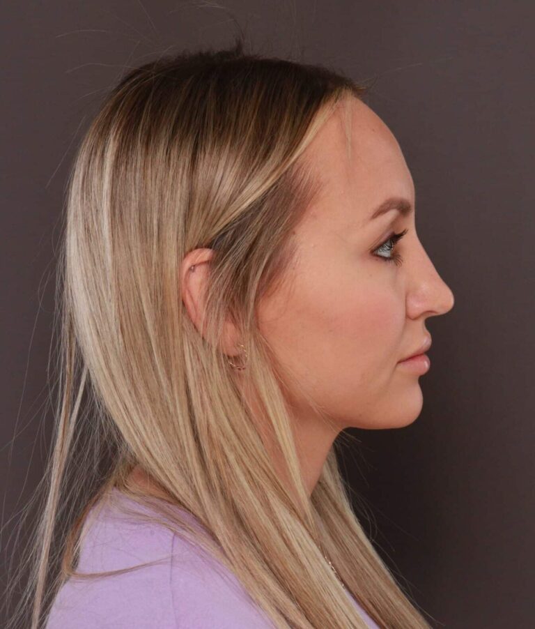 After Image: Forehead Reduction by Dr. Thompson - right-side