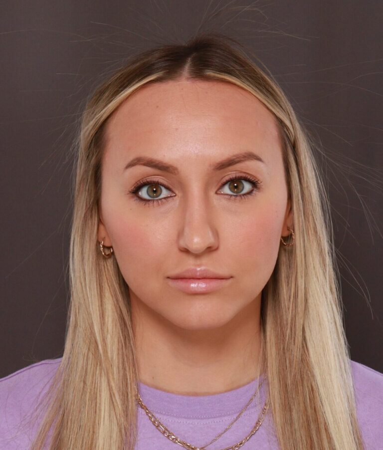 After Image: Forehead Reduction by Dr. Thompson - front