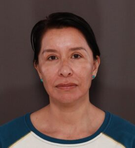 Before Image: MACSlift by Dr. Henstrom