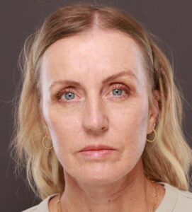 After Image: Facelift & Forehead Reduction by Dr. Thompson