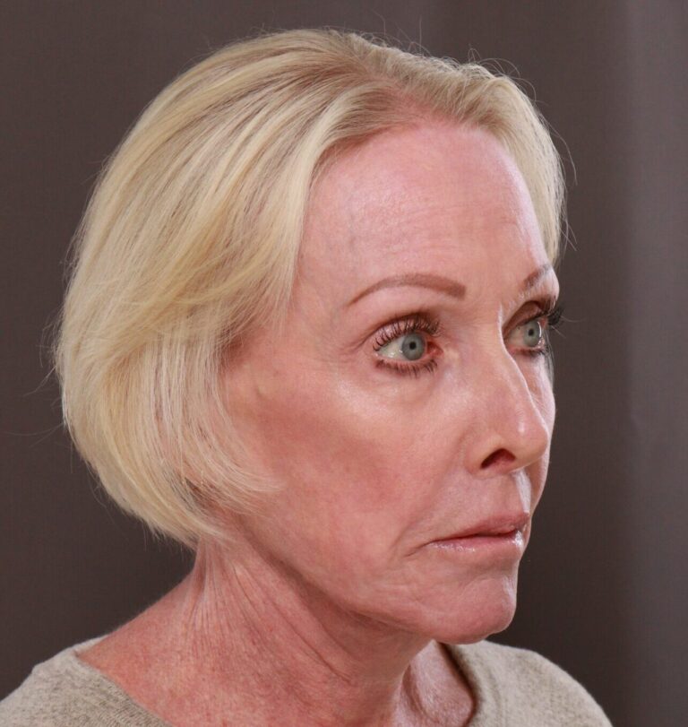 After Image: Facelift, Browlift, Lip Lift & Contour TRL by Dr. Manning - right-front-oblique