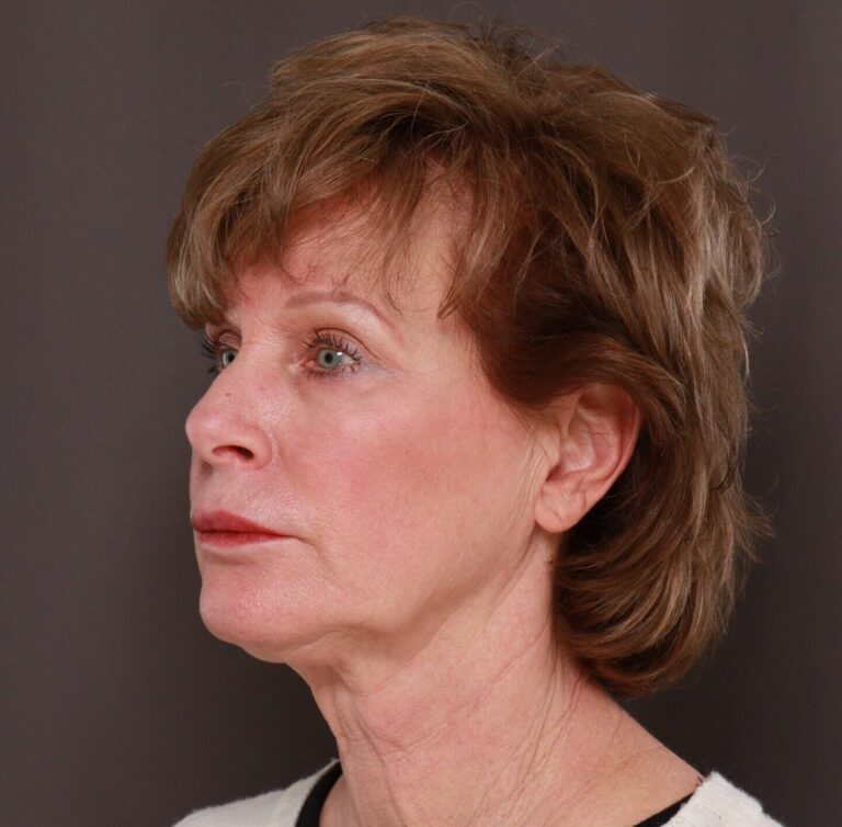 Before Image: Facelift, Lower Blepharoplasty with Periorbital Fat Grafting by Dr. Thompson - left-front-oblique