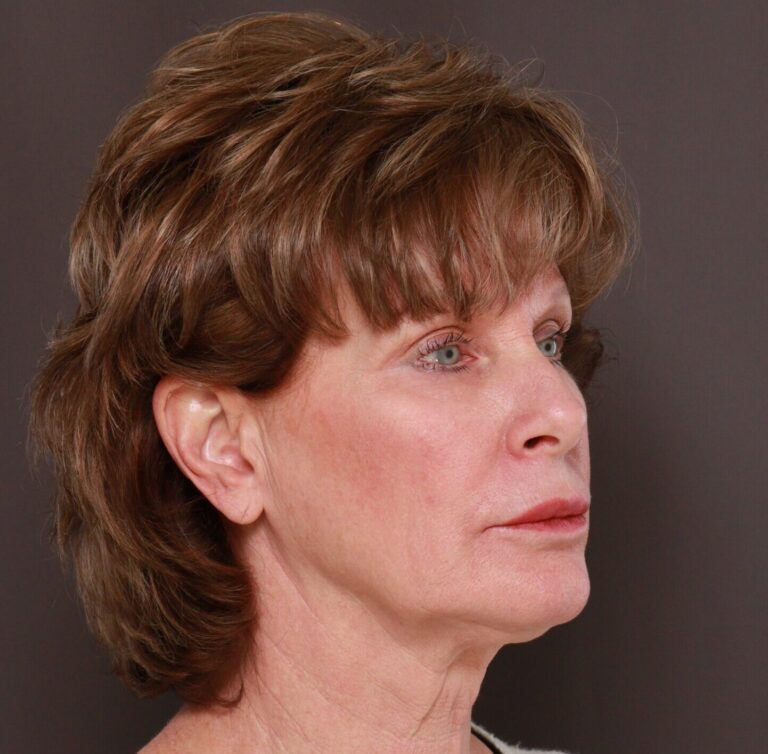 Before Image: Facelift, Lower Blepharoplasty with Periorbital Fat Grafting by Dr. Thompson - right-front-oblique