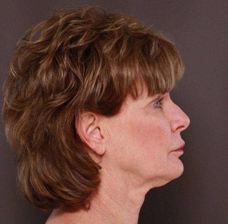 Before Image: Facelift, Lower Blepharoplasty with Periorbital Fat Grafting by Dr. Thompson - right-side
