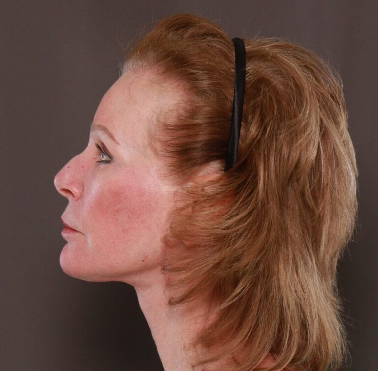 After Image: Facelift, Lower Blepharoplasty with Periorbital Fat Grafting by Dr. Thompson - left-side