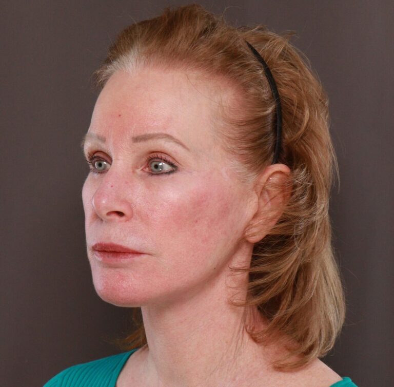 After Image: Facelift, Lower Blepharoplasty with Periorbital Fat Grafting by Dr. Thompson - left-front-oblique